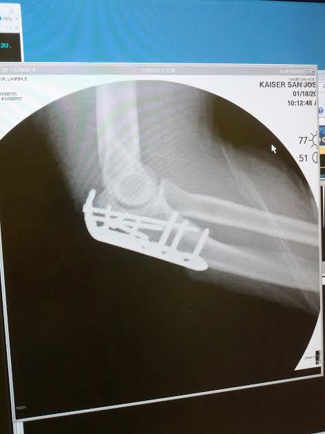 A broken elbow, courtesy of San Francisco's streets. Photo: Lauren Sailor