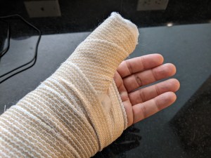 My hand after the crash